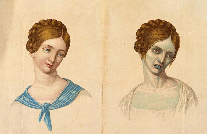 A young Viennese woman aged 23 depicted before and after contamination. Bron: Wellcome Collection